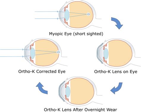 Orthokeratology (Ortho.